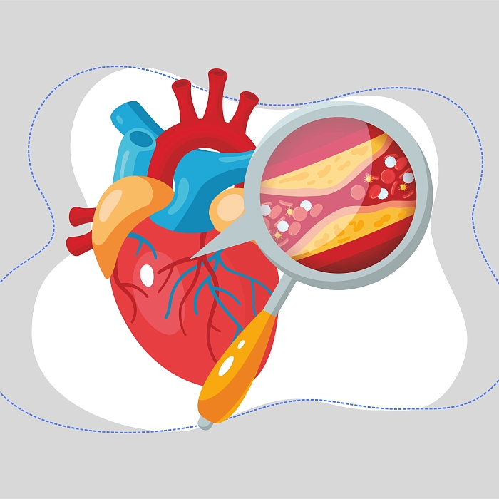 Как привести холестерин в норму: вся правда о «плохом» и «хорошем» холестерине